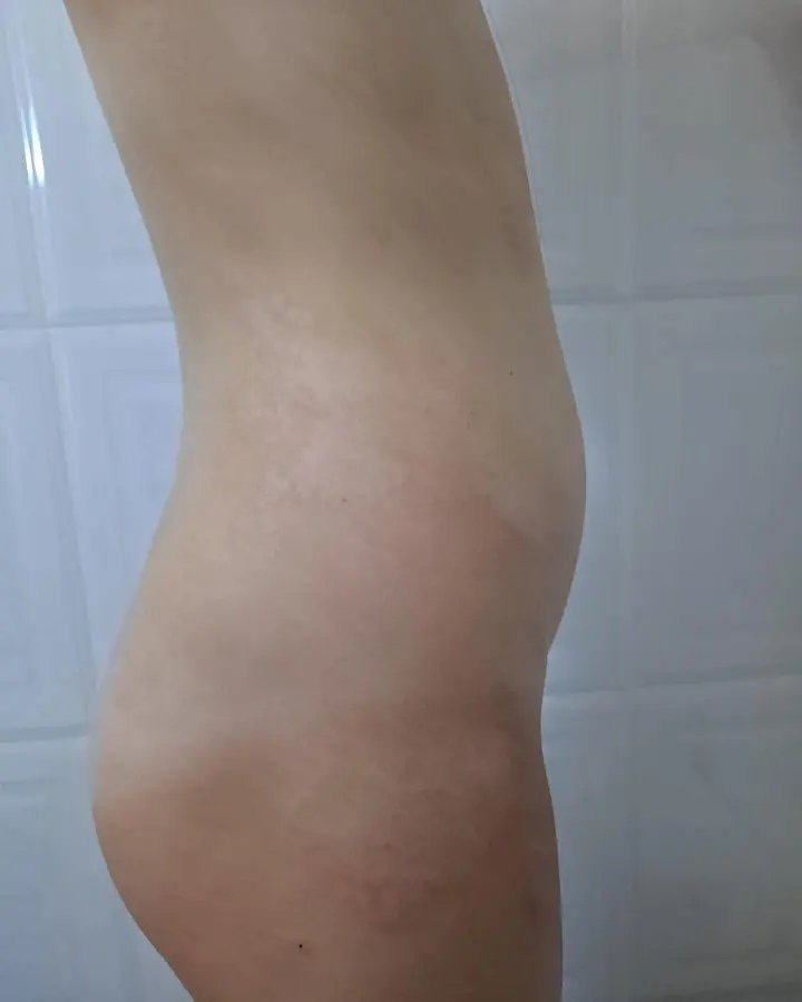 Piel atópica severa